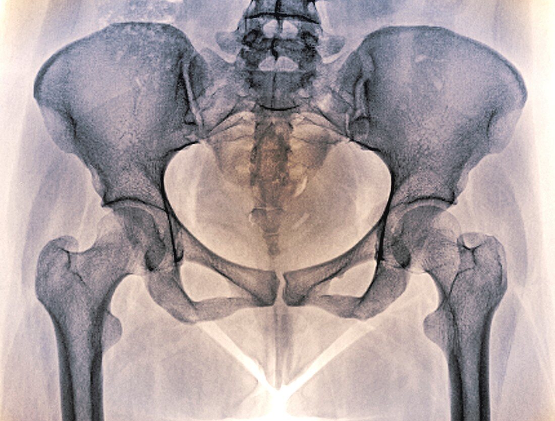 Female pelvis bones and joints, X-ray
