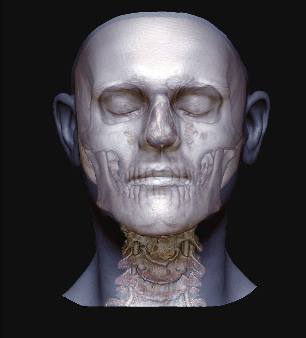 Human head, skull and spine, 3D CT angiogram