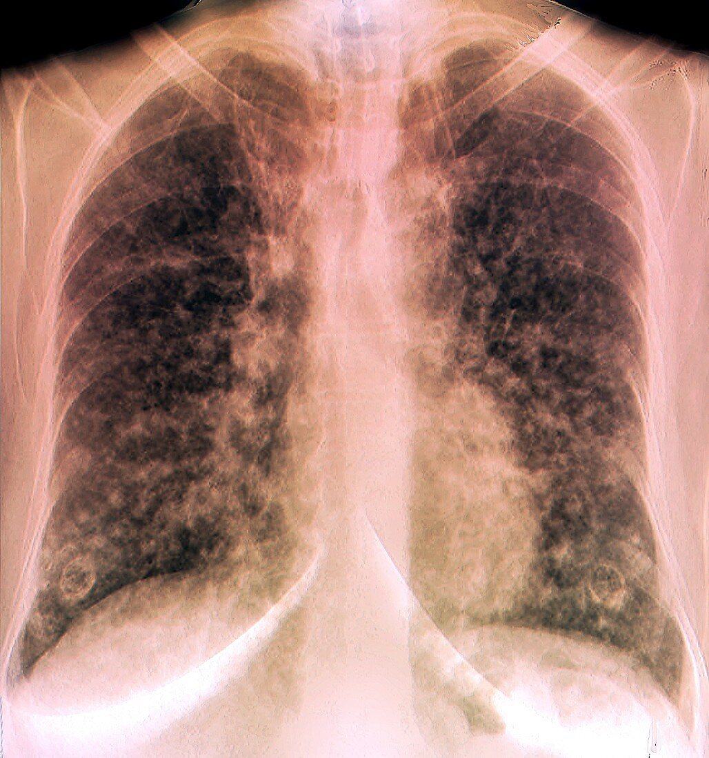 Terminal lung cancer, X-ray