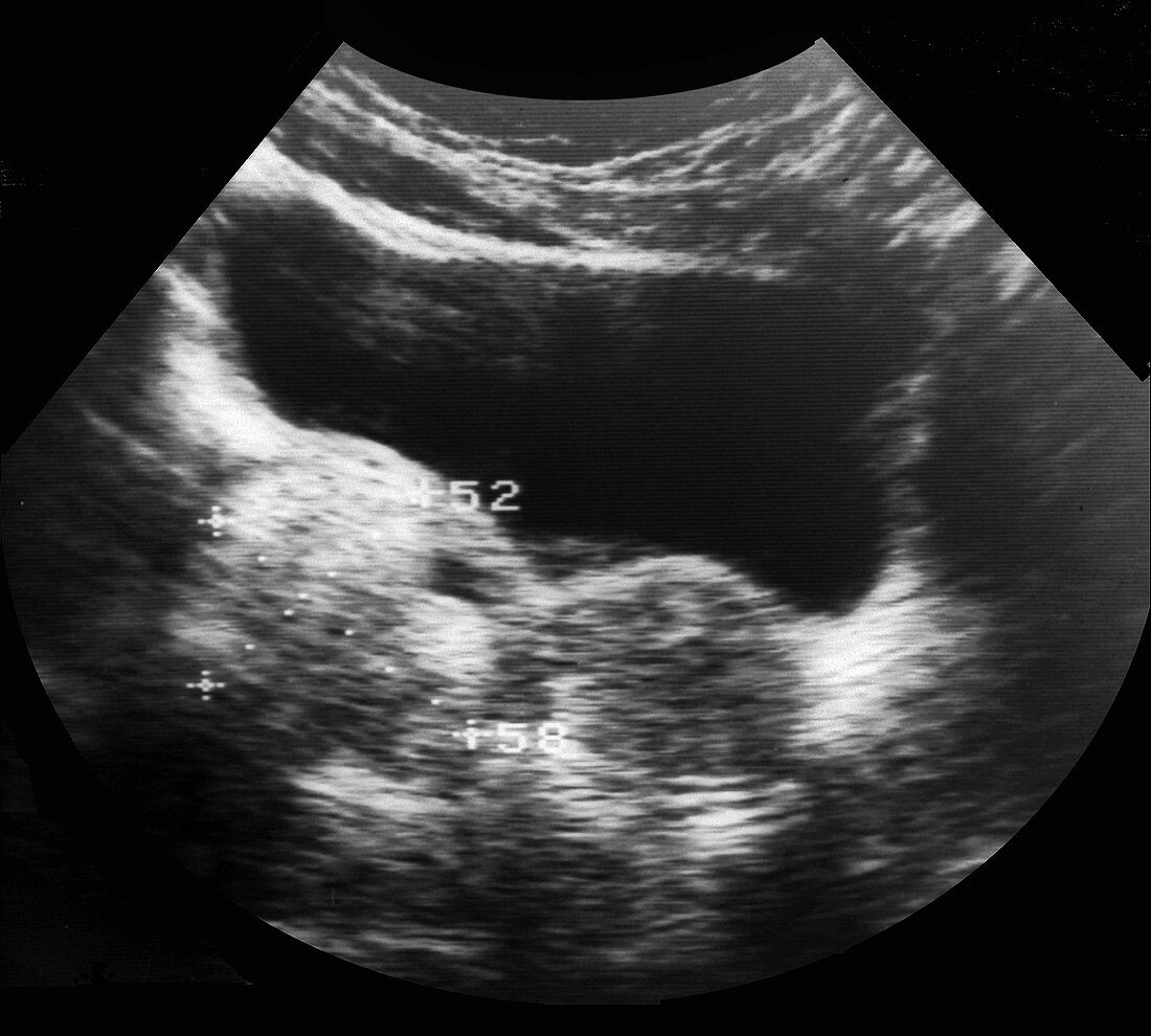 Dermoid ovarian cyst, ultrasound scan