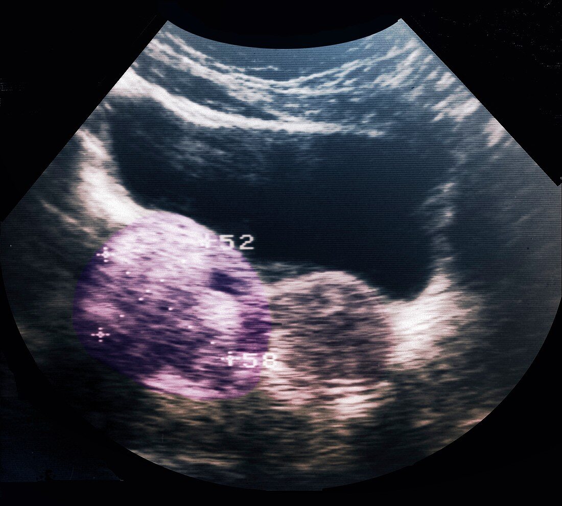 Dermoid ovarian cyst, ultrasound scan