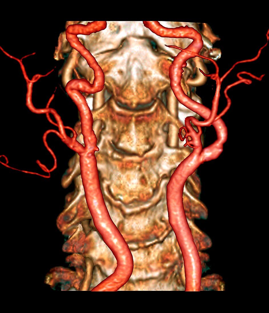 Carotid artery disease, 3D CT angiogram