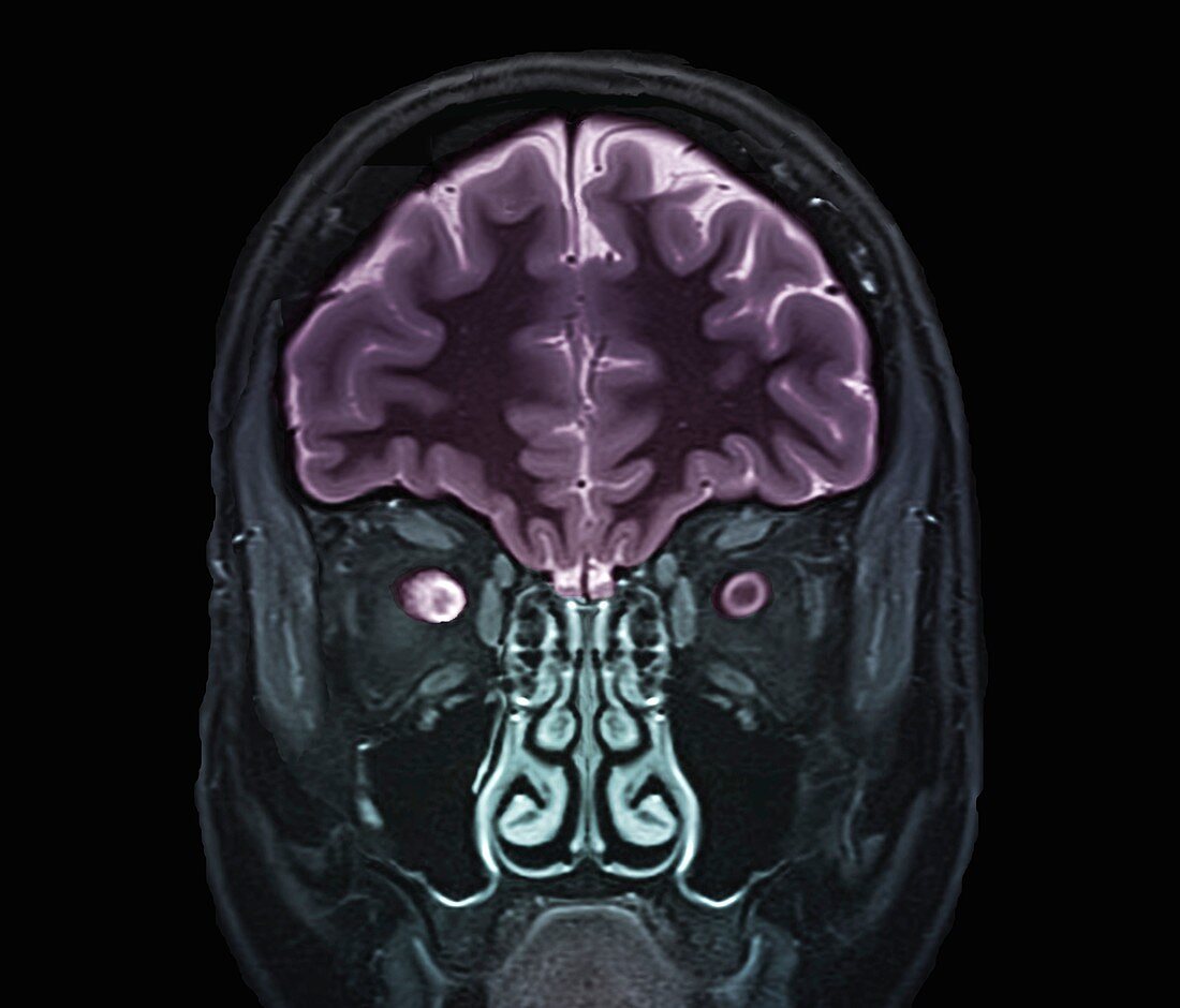 Optic nerve multiple sclerosis symptom, MRI scan