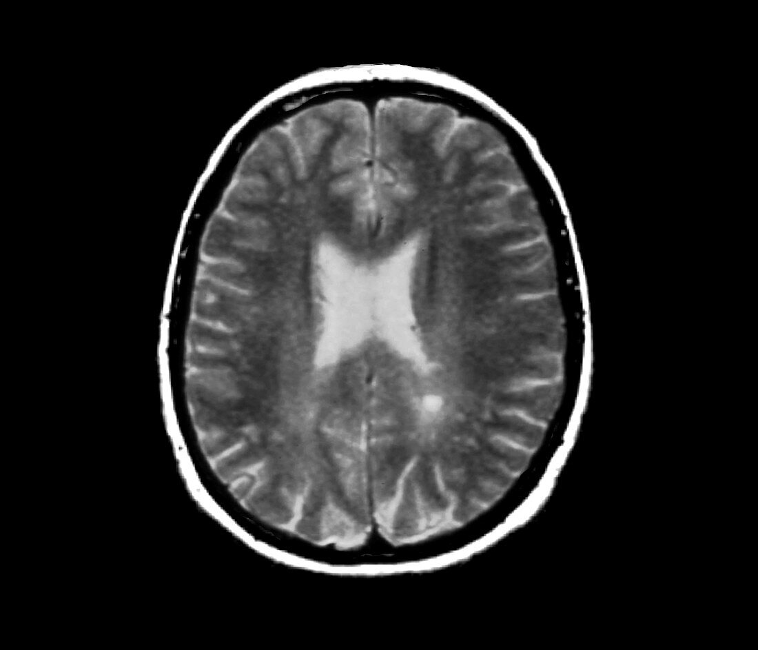 Lyme encephalopathy, MRI scan