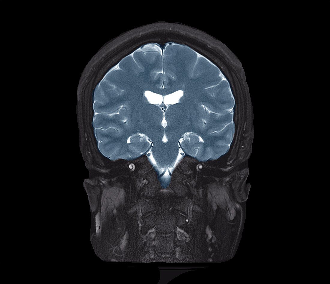 Human brain, coronal MRI scan