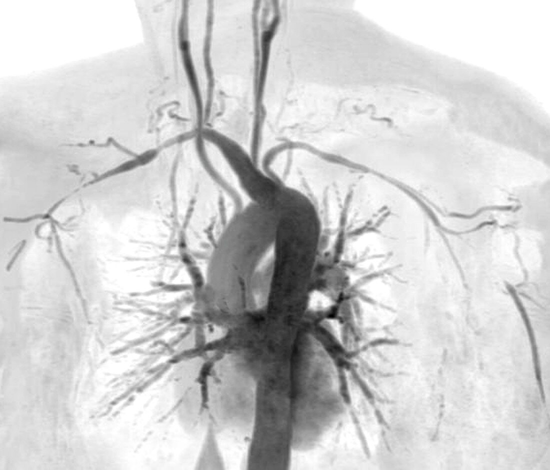 Takayasu's arteritis, MRI angiogram
