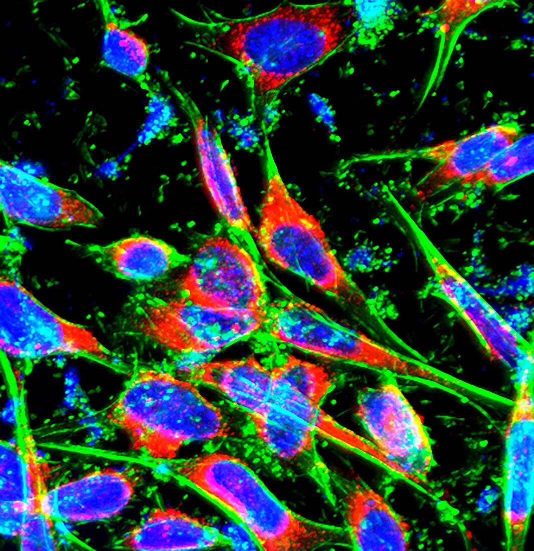 Colon cancer cells, fluorescence light micrograph