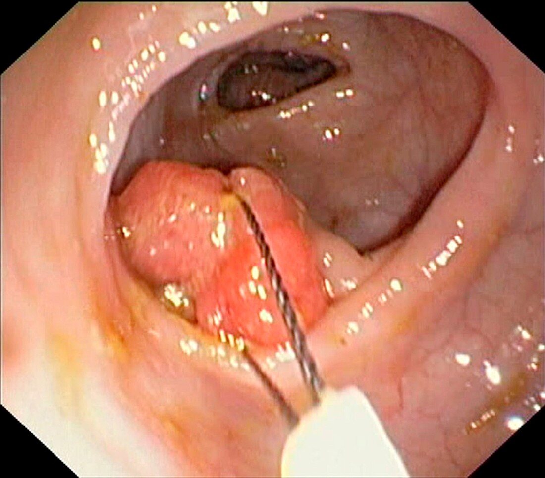 Colonic polypectomy, endoscope view