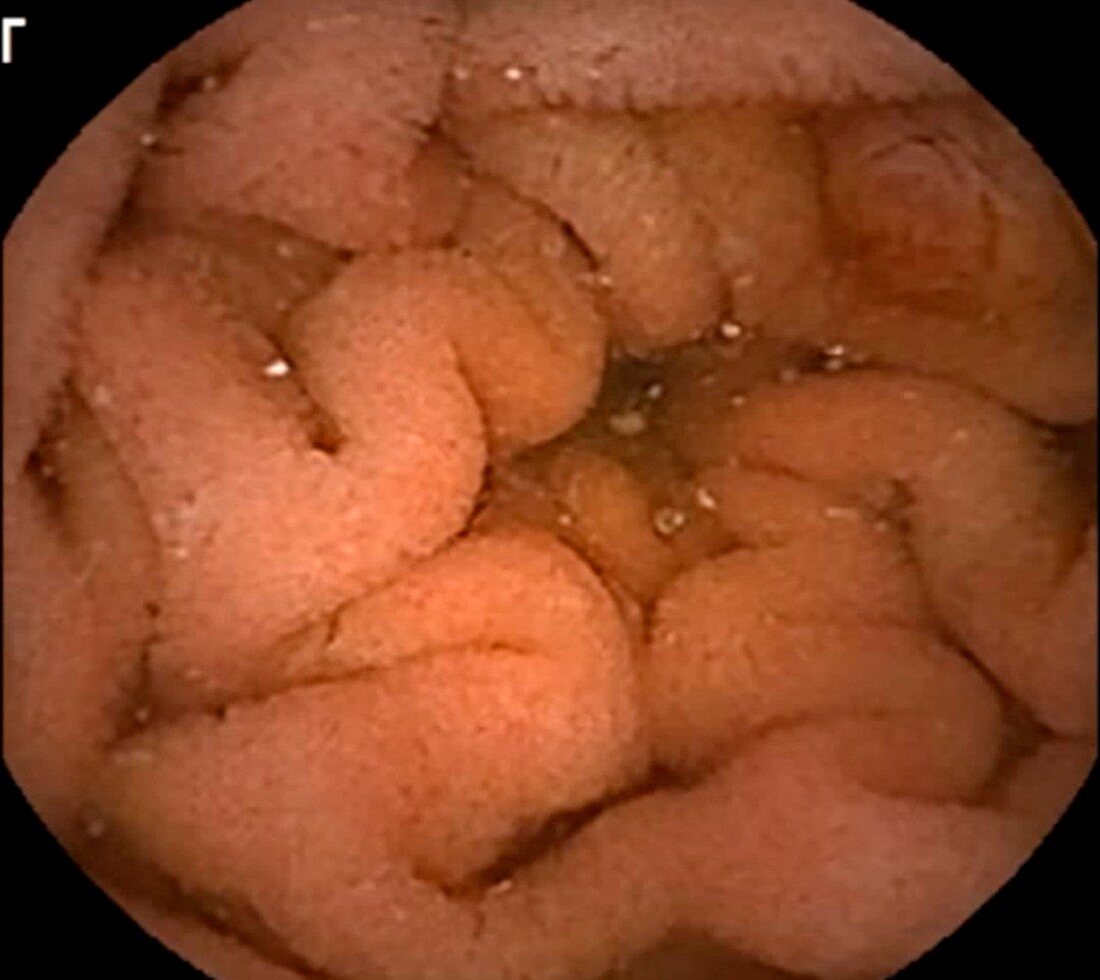 Normal descending duodenum, capsule endoscope view