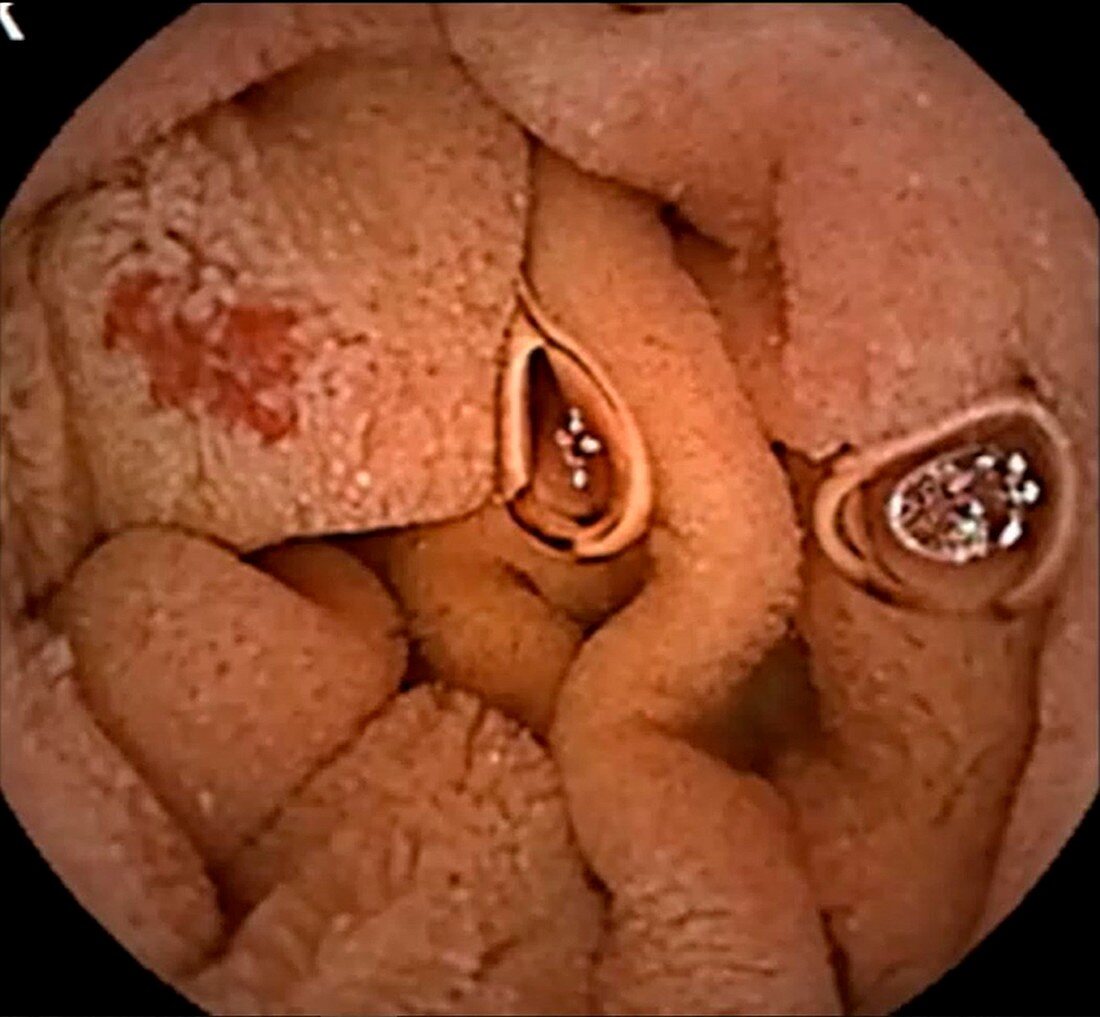 Angiectasia in small intestine, capsule endoscope view