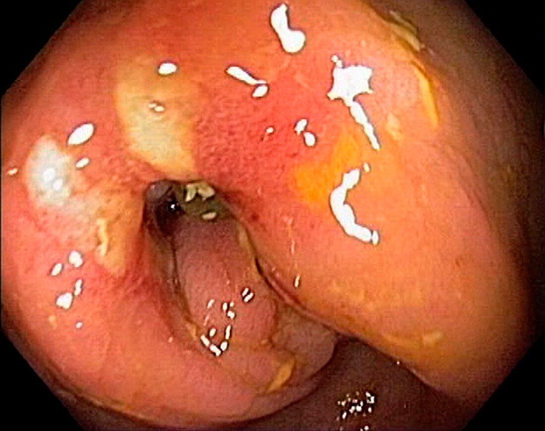Colon cancer and Crohn's disease, endoscopic view