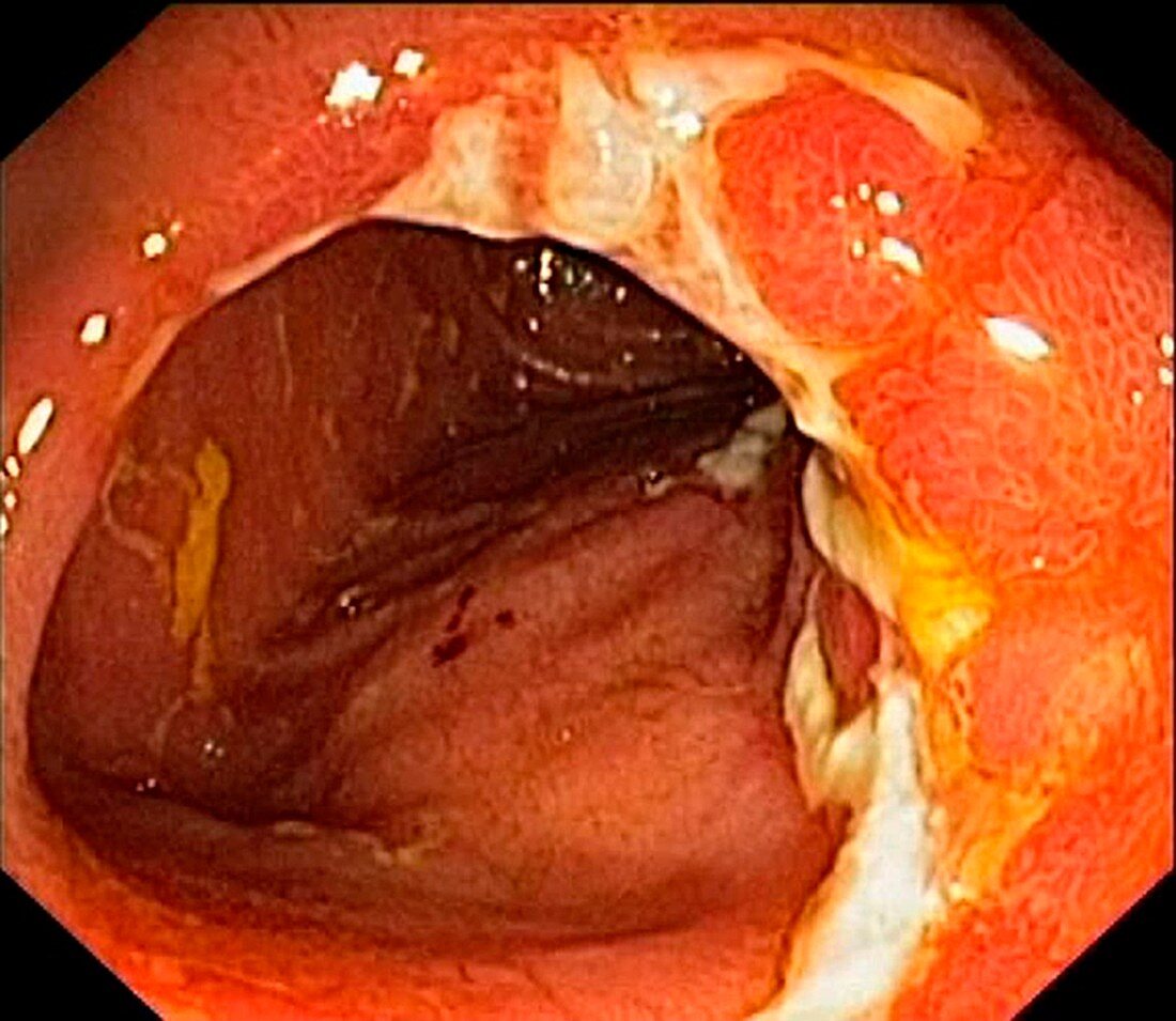 Crohn's disease in the ileum, endoscopic view