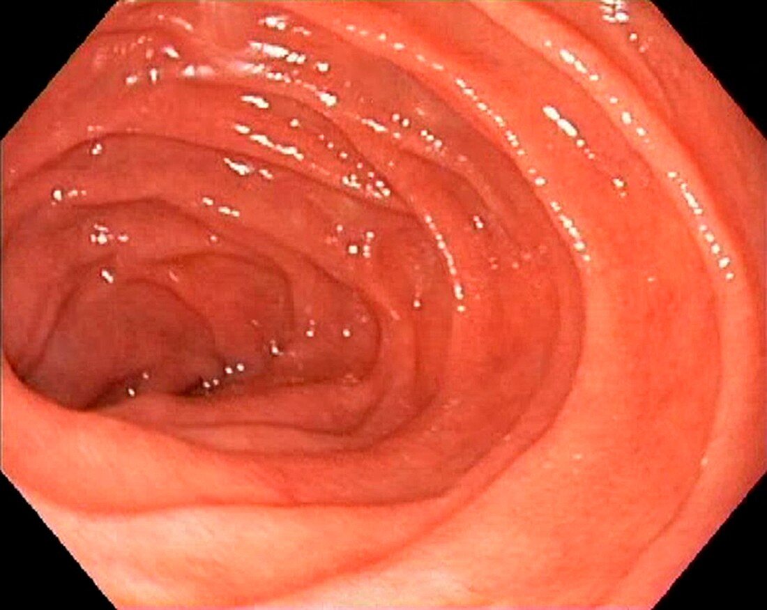 Healthy duodenum, endoscope view