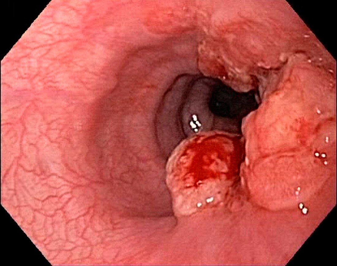 Oesophageal cancer, endoscopic view