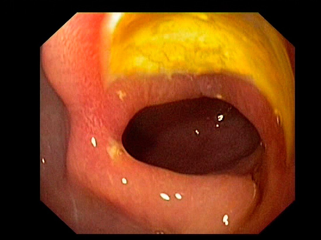 Prepyloric stomach ulcer, endoscopic view