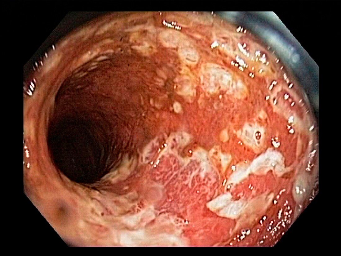 Ulcerative colitis, endoscope view