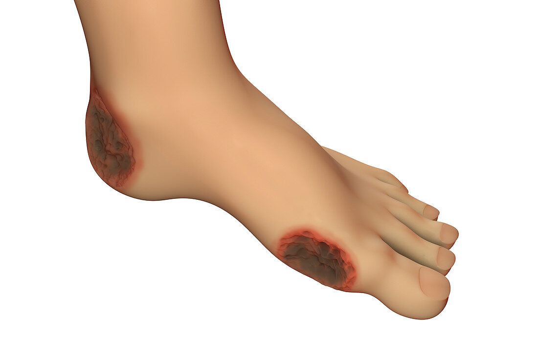 Diabetic foot ulcers, illustration