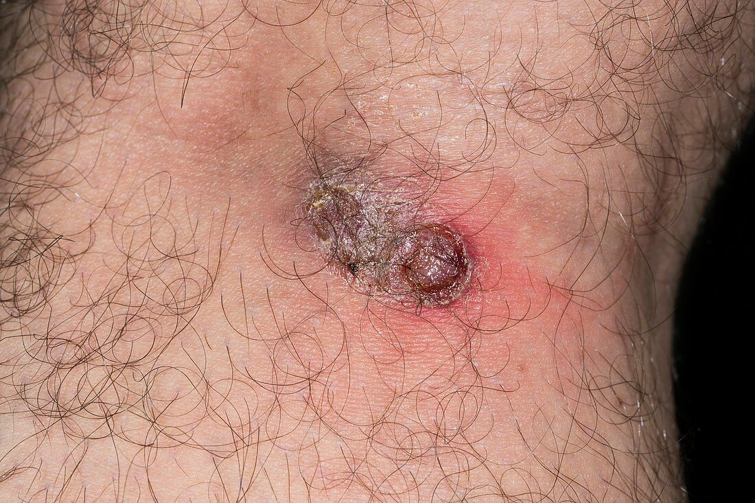 Cutaneous leishmaniasis lesion