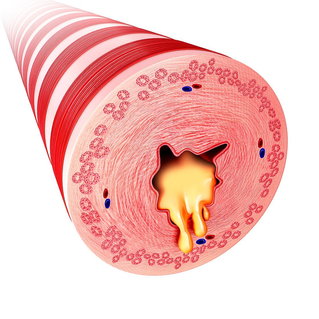 Bronchus with excess mucus, illustration