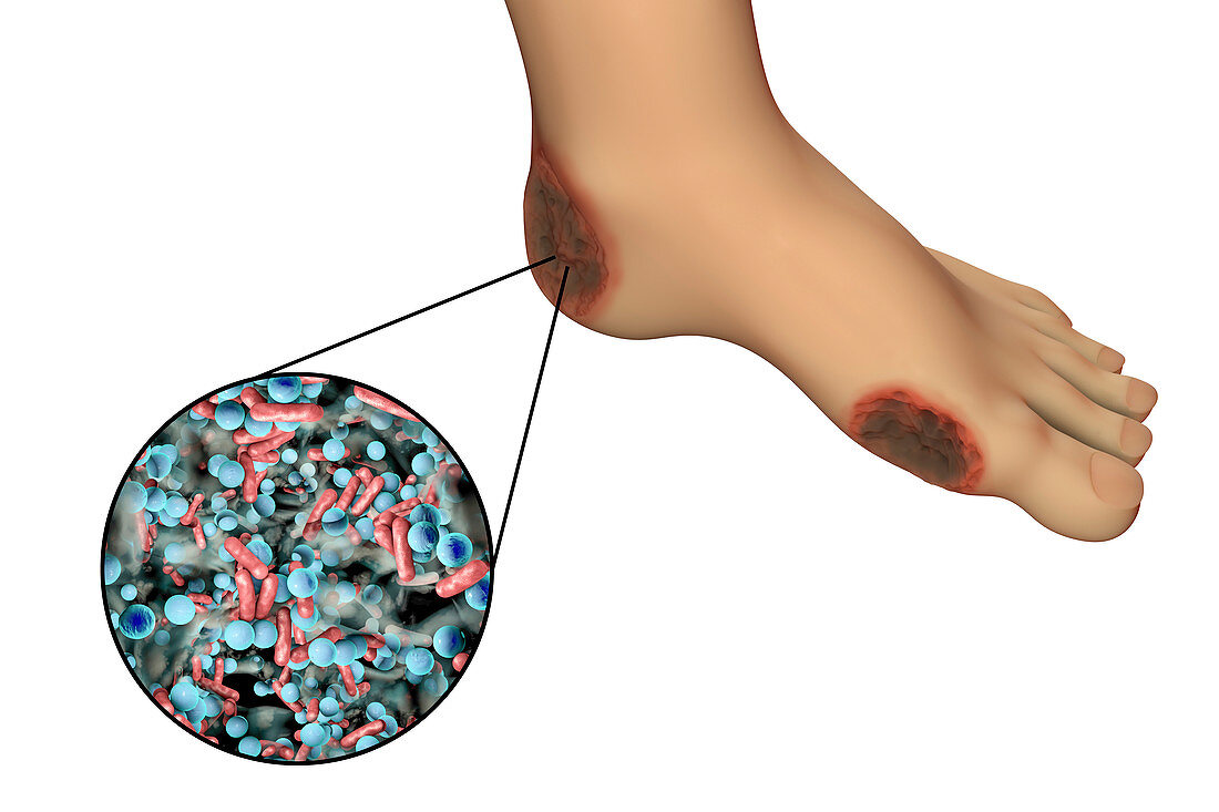 Destruction of Cytomegalovirus, illustration