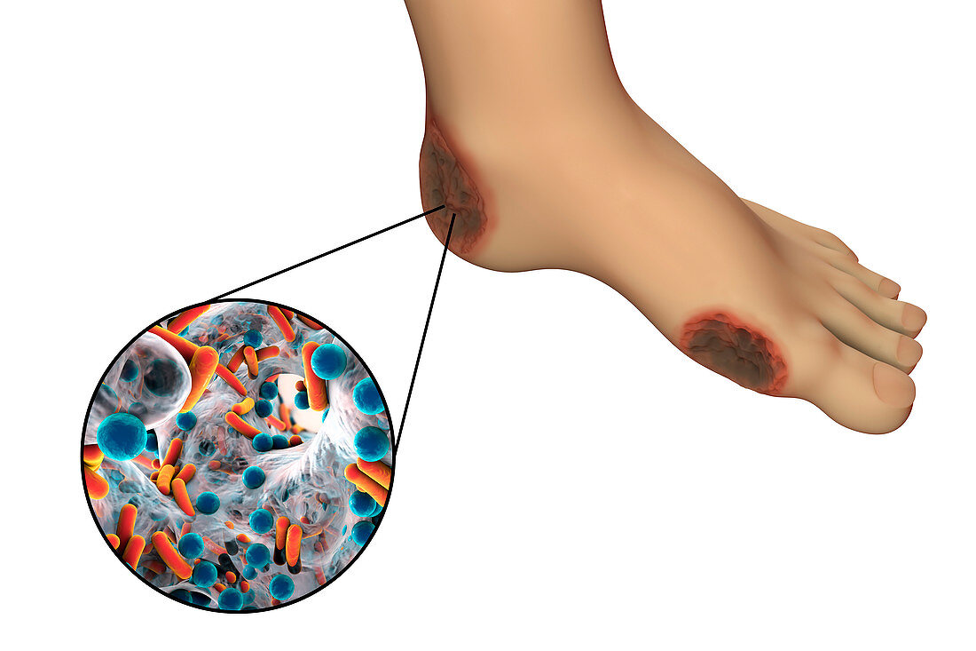 Destruction of Cytomegalovirus, illustration