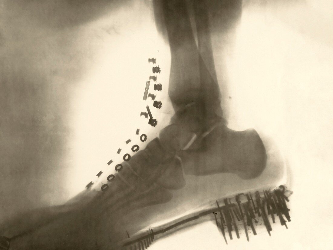 Foot and shoe X-ray, 1896