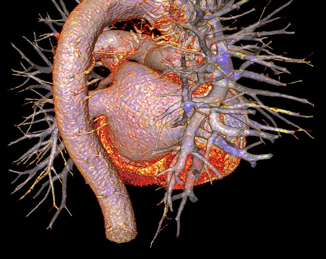 Human heart, 3D CT scan