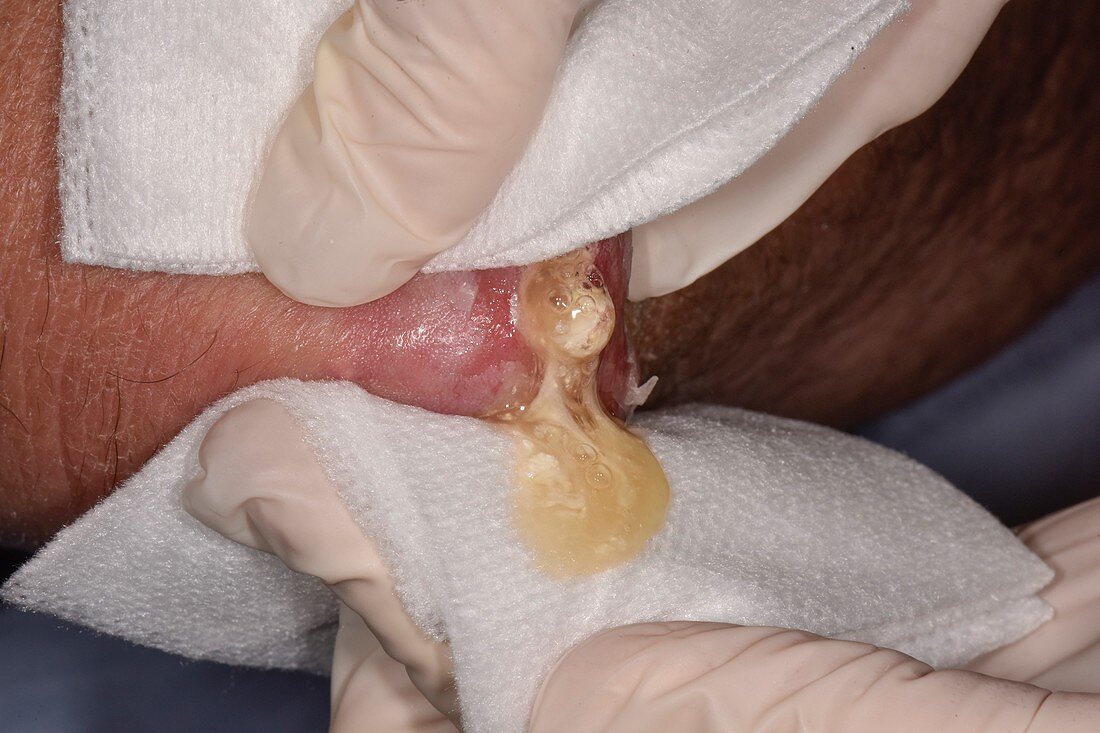 Draining ruptured tophus in gout