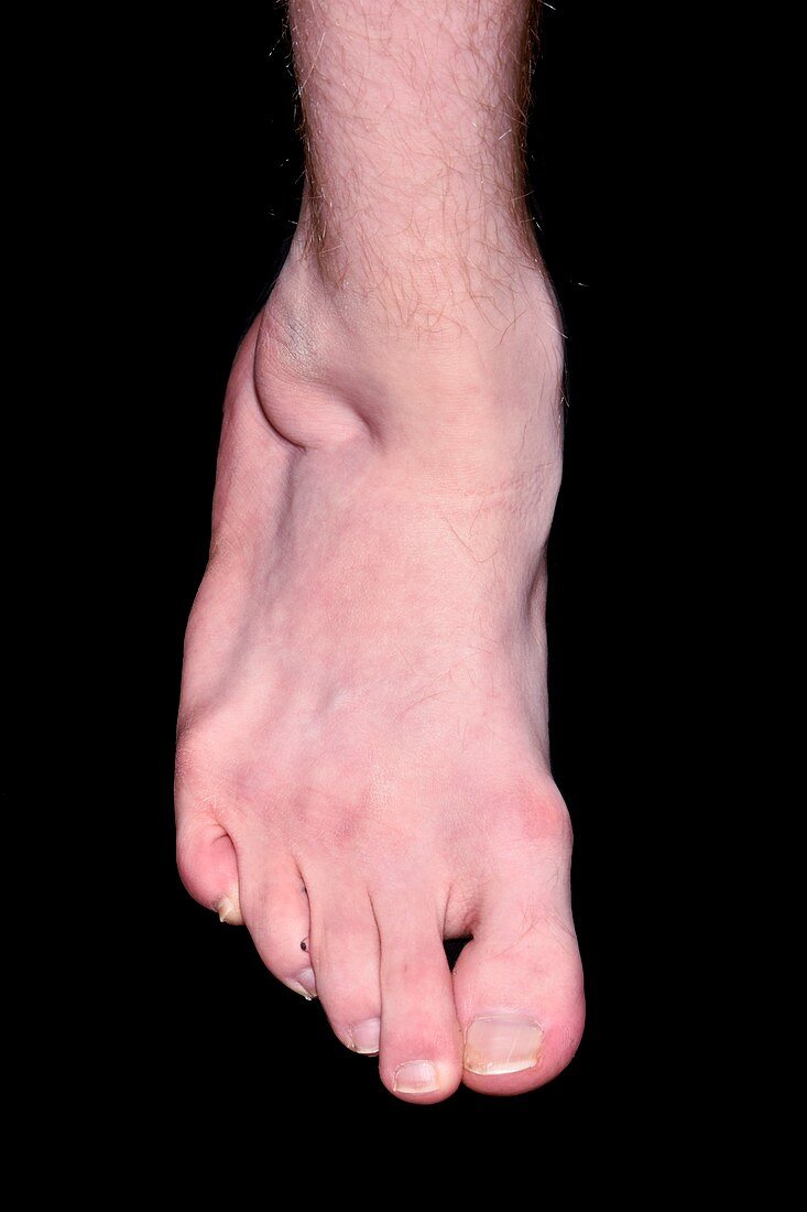 Club foot following surgery in childhood