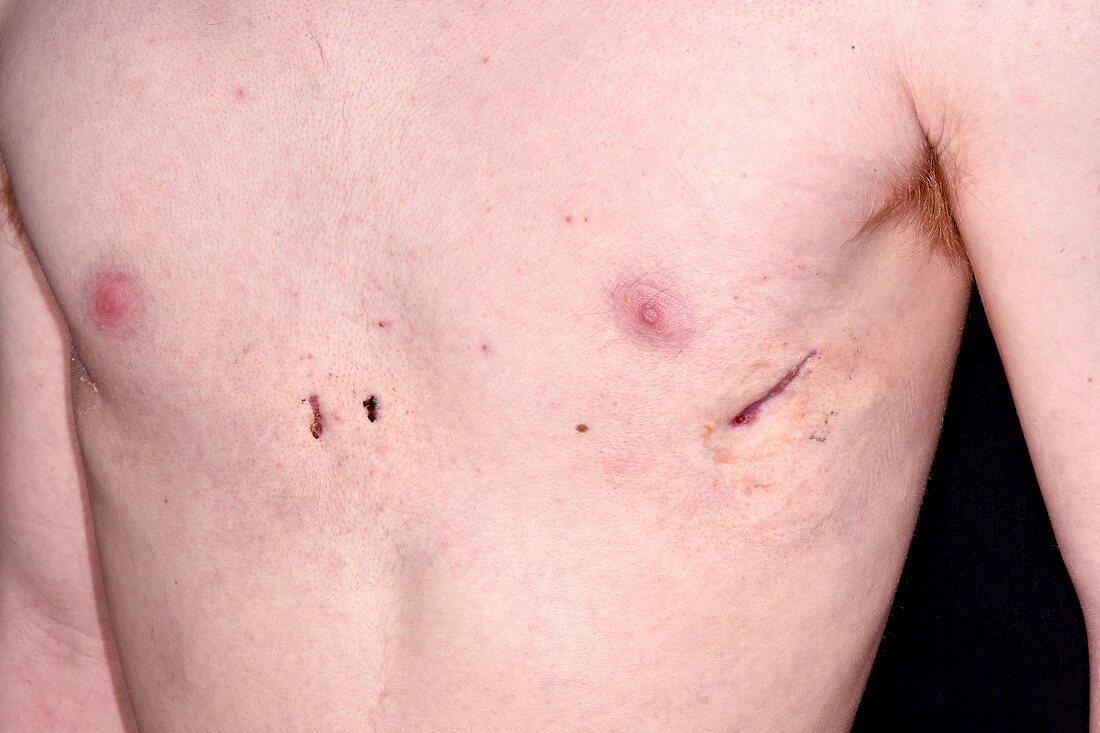 Hollowed chest following corrective surgery