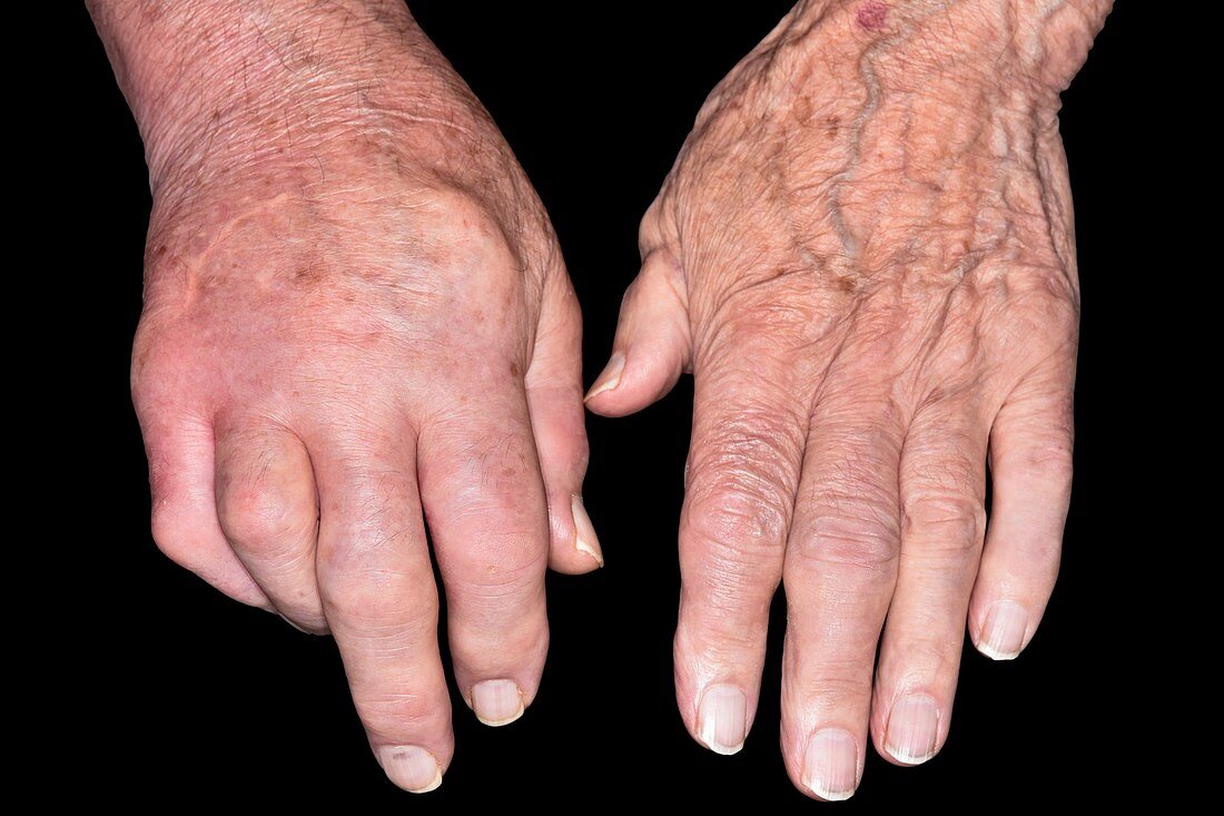 Swollen hand in gout