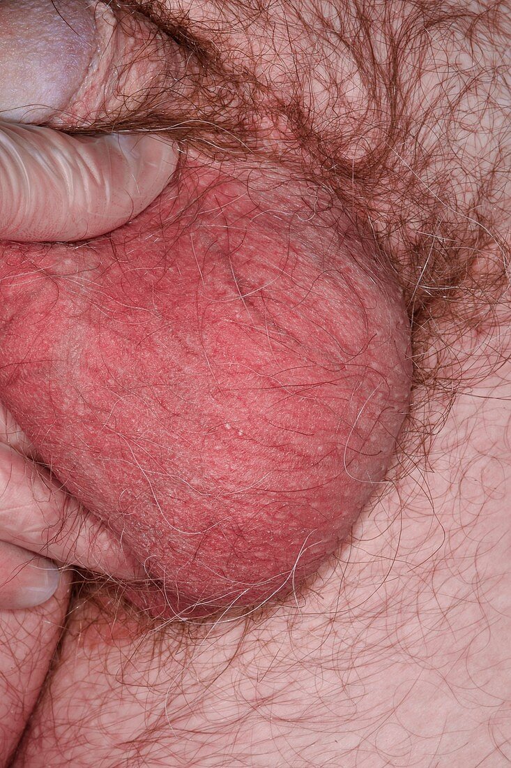 Testicular cancer