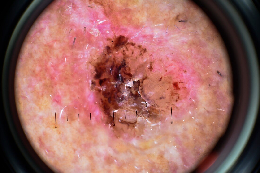 Squamous cell carcinoma skin cancer, dermatoscopy