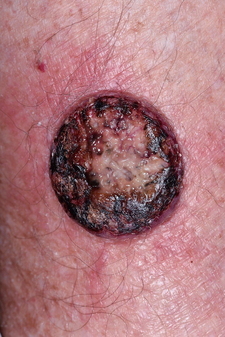 Squamous cell carcinoma skin cancer