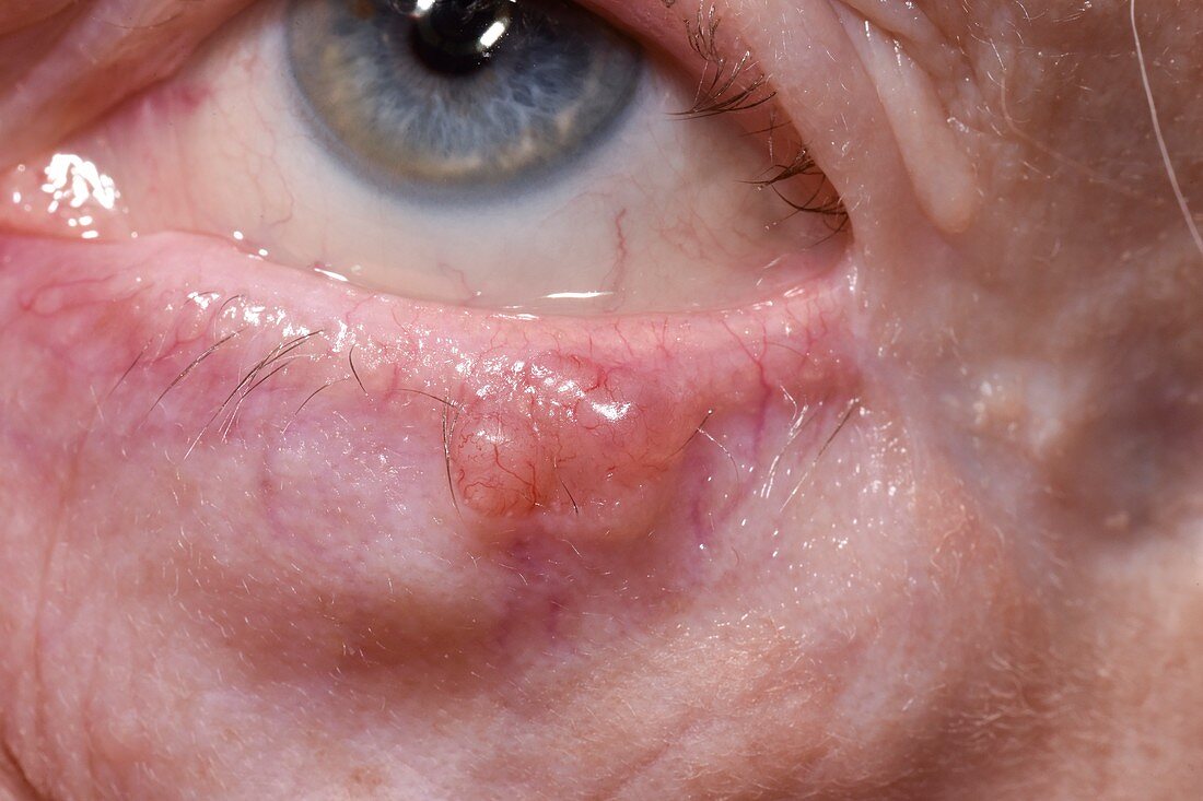 Basal cell carcinoma of the eye
