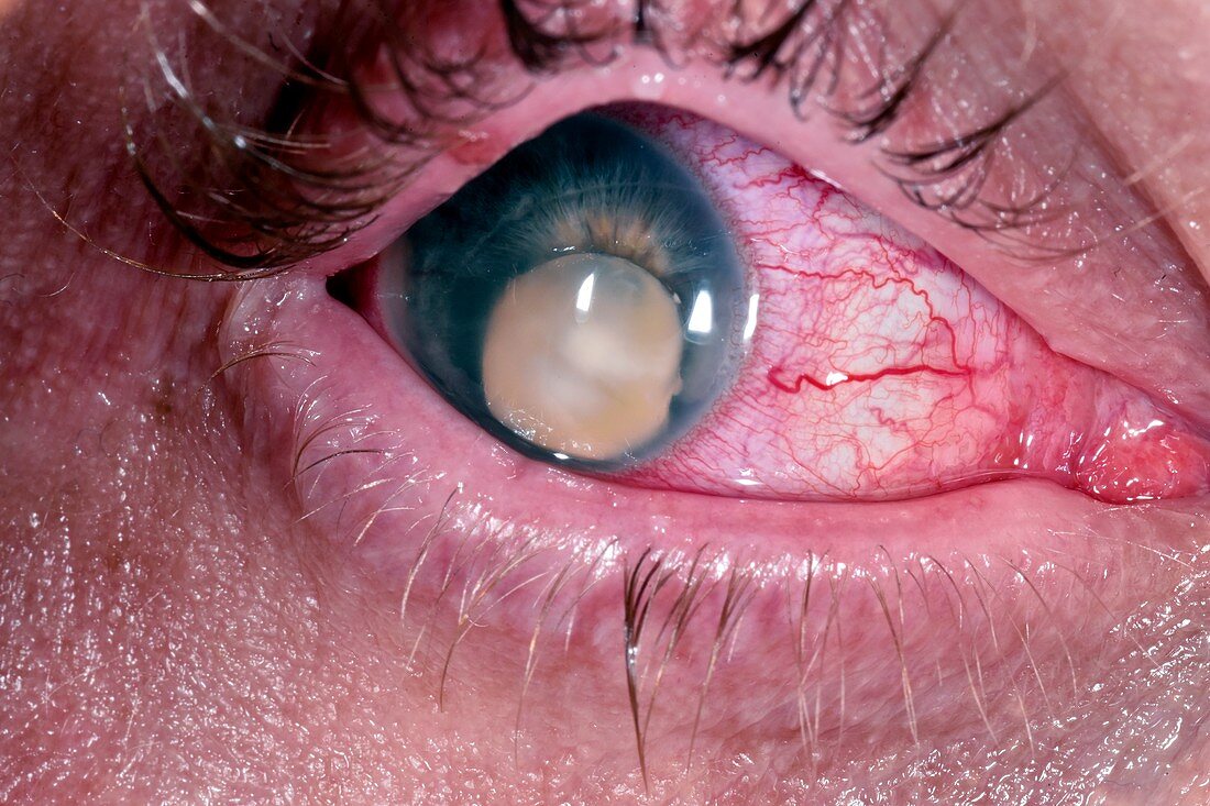 Cataract and retinal detachment in Coats' disease