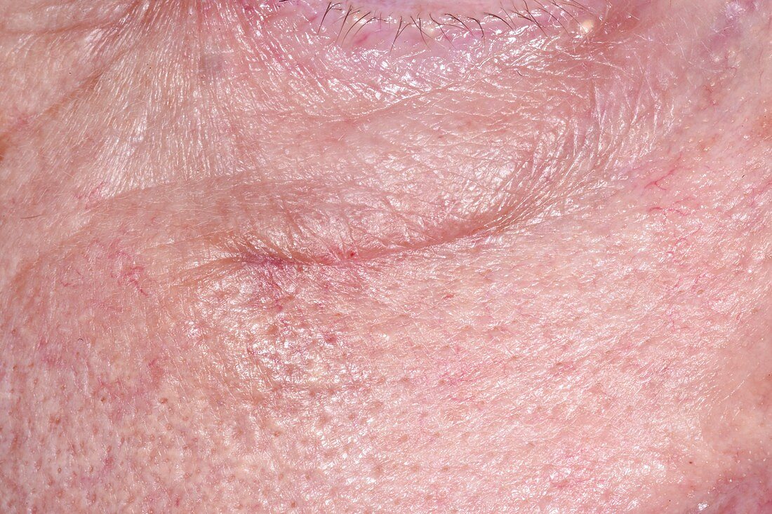 Chondroid syringoma after removal