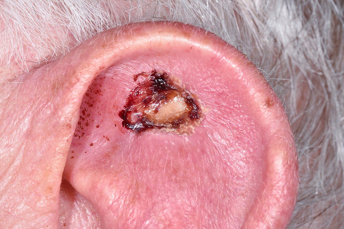 Basal cell carcinoma skin cancer after removal