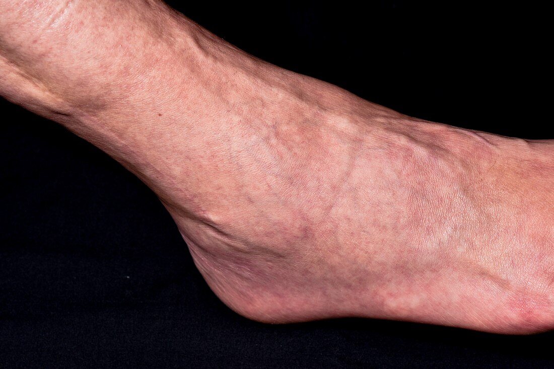 Swollen ankle following horse riding accident