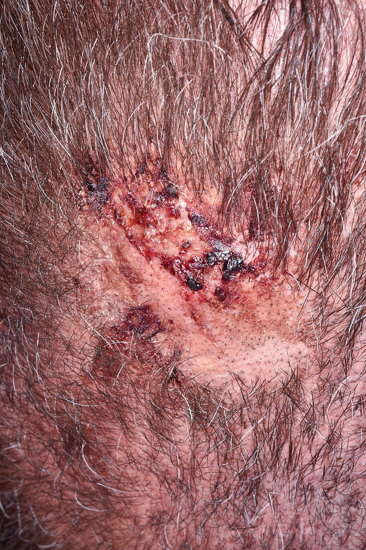 Head injury after fall
