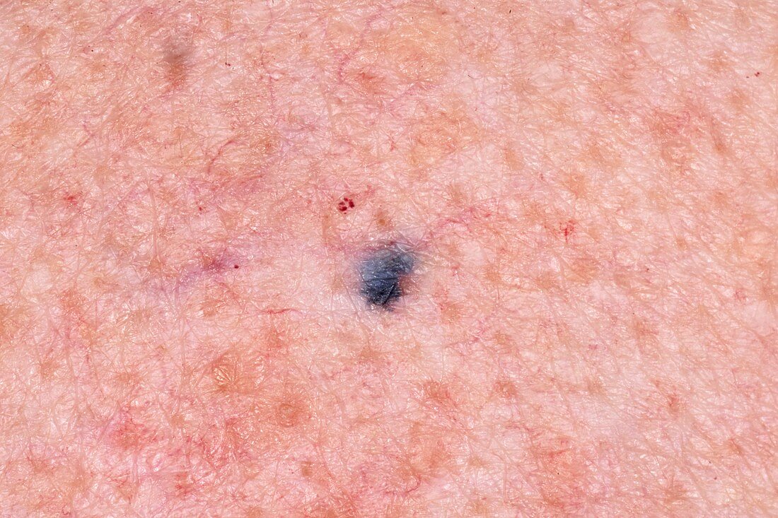 Radiotherapy tattoo mark