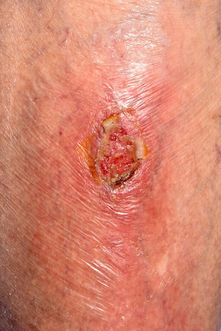 Infected ulcer