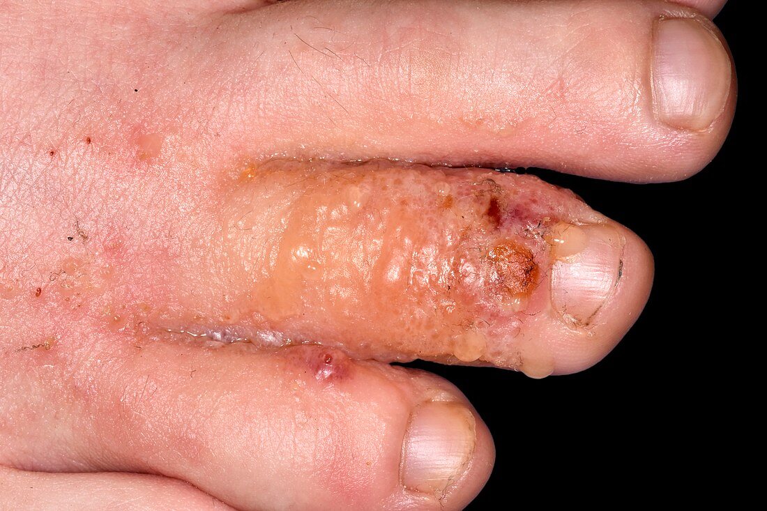 Infected toe injury