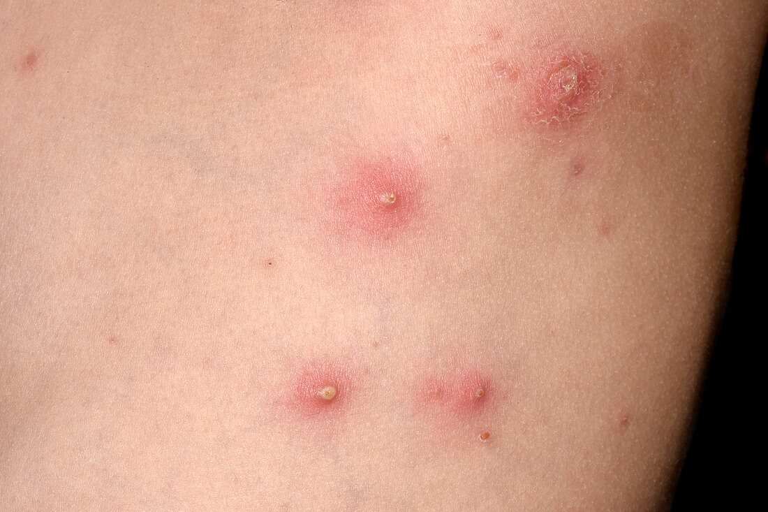 Folliculitis on the chest