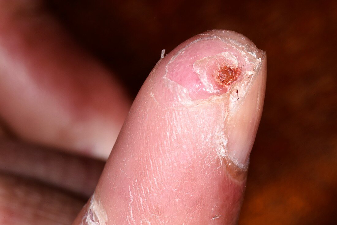 Finger wound after treatment