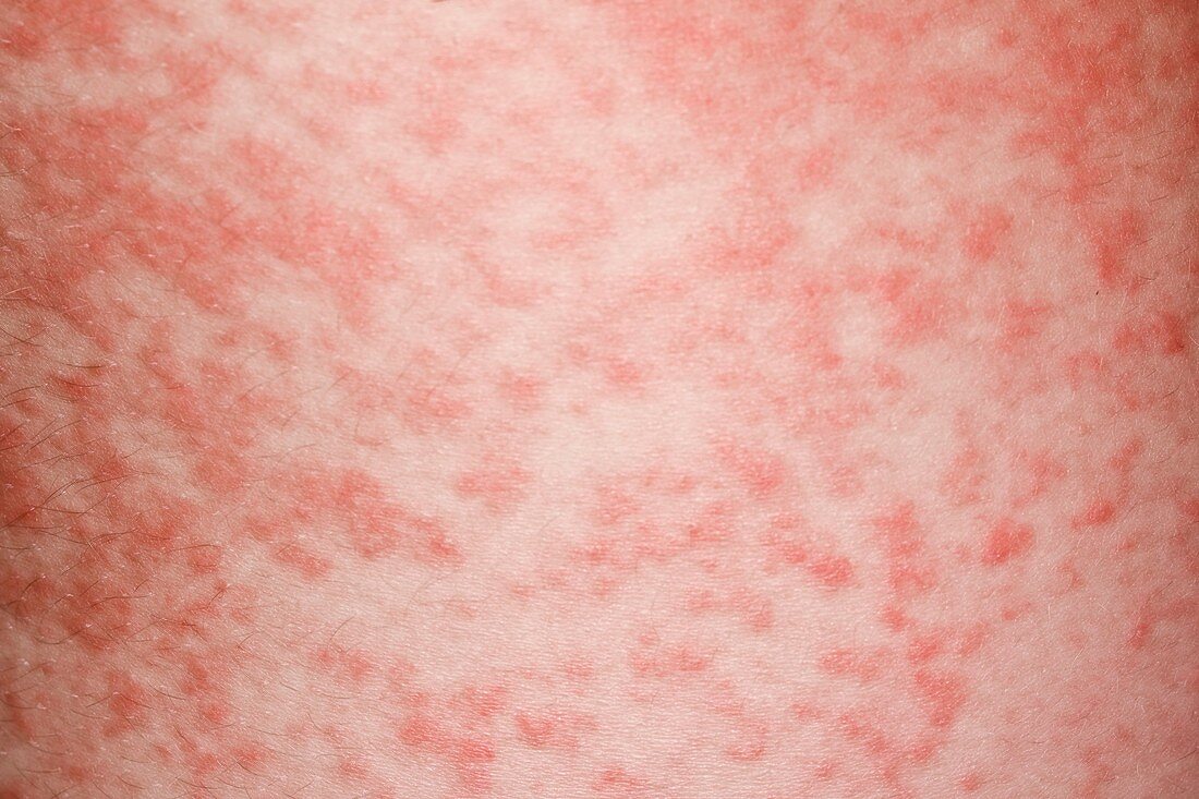 Amoxicillin rash in glandular fever