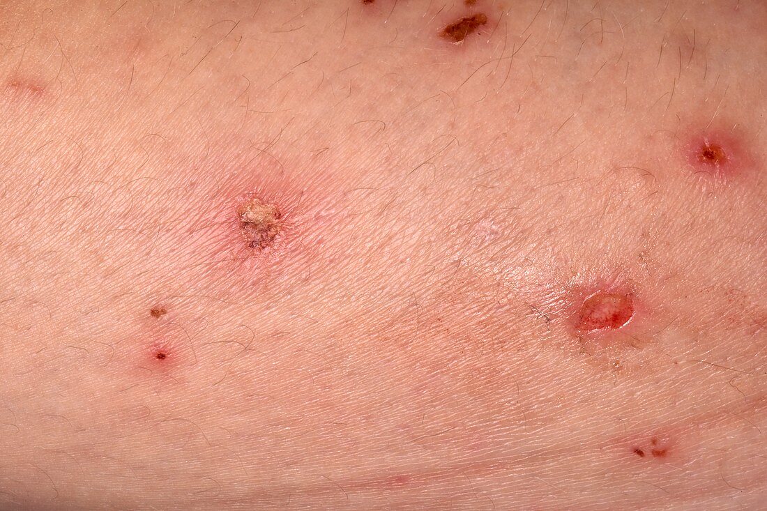 Infected eczema rash