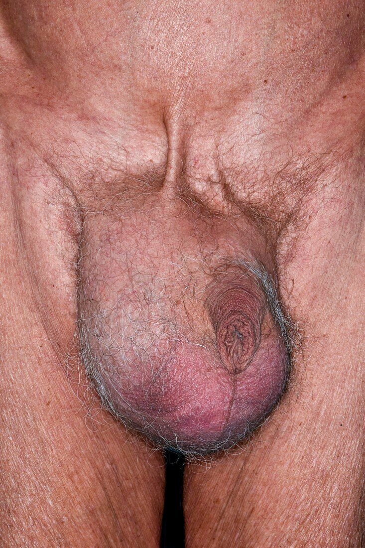 Swollen testicles