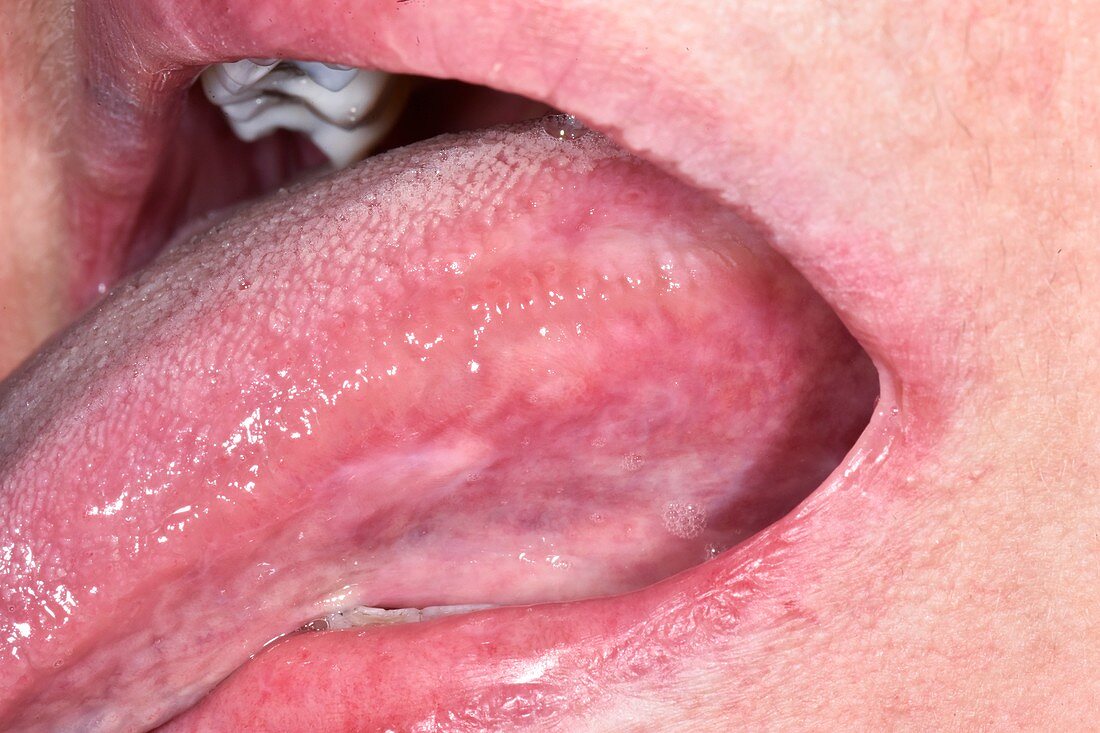 Oral submucous fibrosis