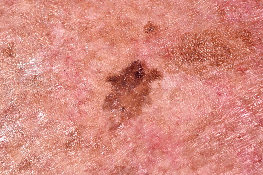 Hutchinsons lentigo skin cancer